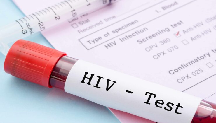 Hiv Testi ile Kısa Sürede Hastalık Teşhisi